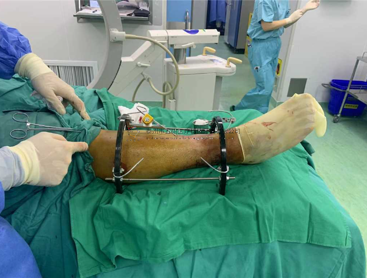 【望京醫(yī)院】不開(kāi)刀治骨折病例分享——小腿骨折伴踝骨折